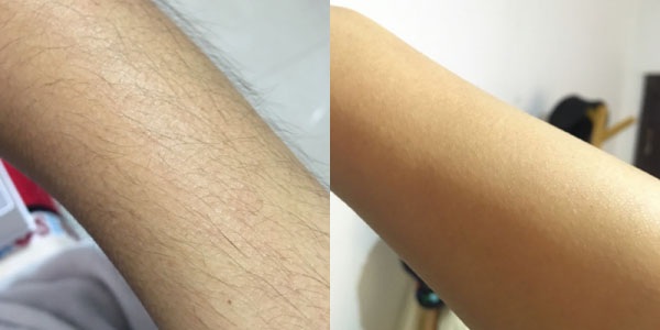 手臂脱毛,不做多毛星人