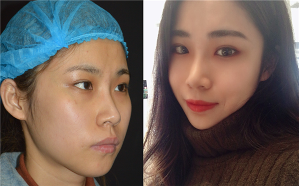 术前我是属于丹凤眼,眼角有点下坠,做了眼综合,做完之后眼睛改善了