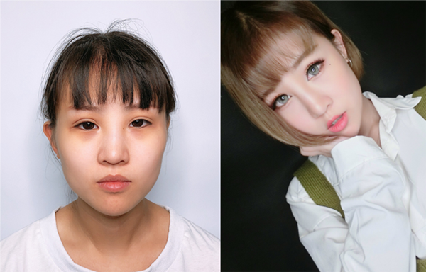 术前我是属于丹凤眼,眼角有点下坠,做了眼综合,做完之后眼睛改善了