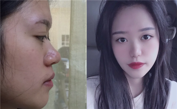 术前我是属于丹凤眼,眼角有点下坠,做了眼综合,做完之后眼睛改善了