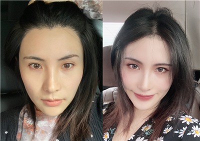 日记本:做完热玛吉感觉皮肤紧致弹润,非常推荐,术后效果前后对比图