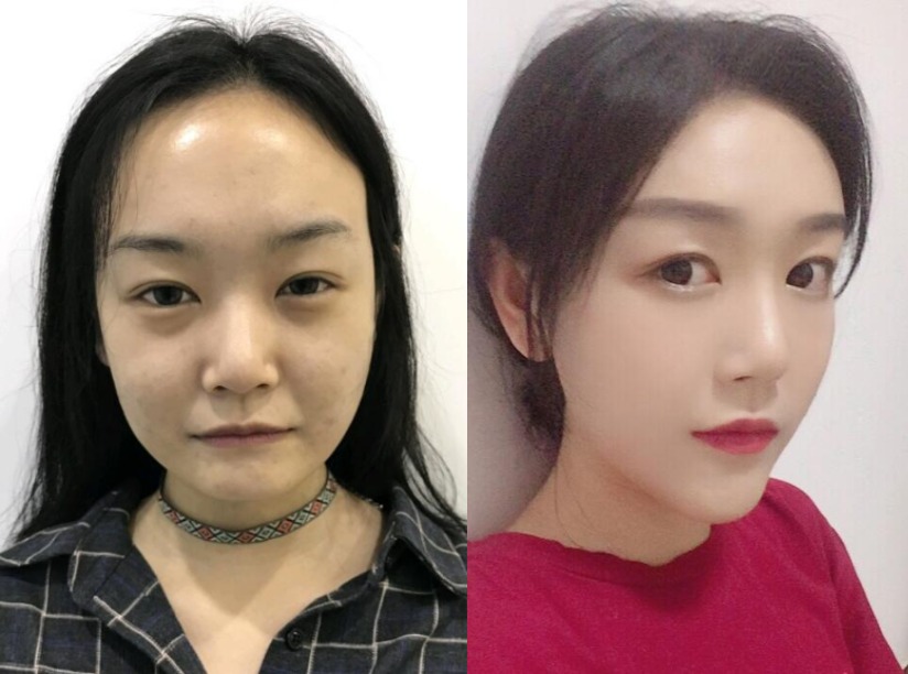 术前我是属于丹凤眼,眼角有点下坠,做了眼综合,做完之后眼睛改善了