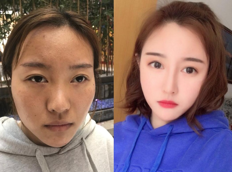 术前我是属于丹凤眼,眼角有点下坠,做了眼综合,做完之后眼睛改善了